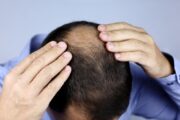 誰にも相談できない「薄毛」の悩みを徹底解説